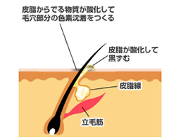 黒ずみ毛穴