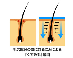 開き毛穴